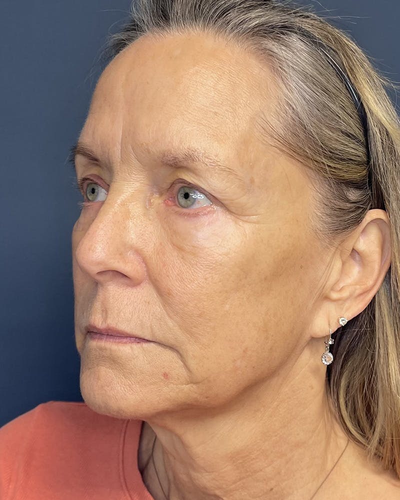 Sculptra Before & After Gallery - Patient 428497 - Image 3
