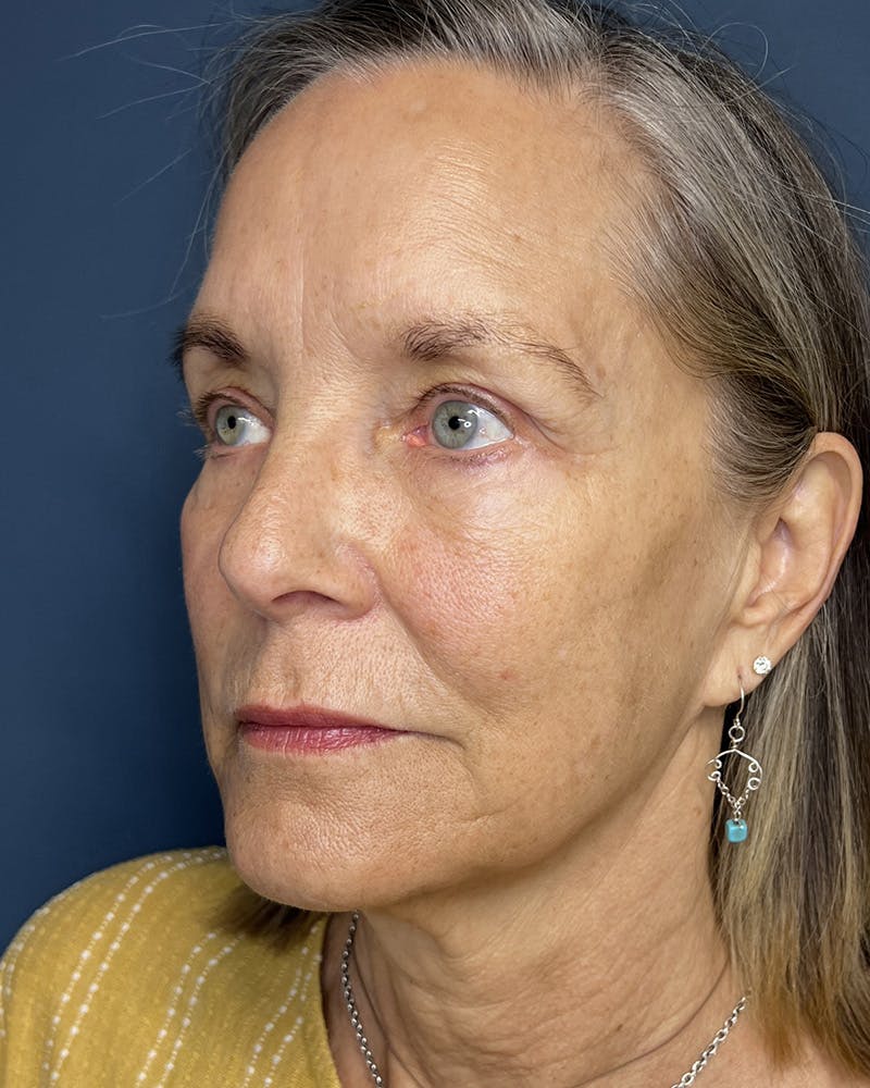 Sculptra Before & After Gallery - Patient 428497 - Image 4