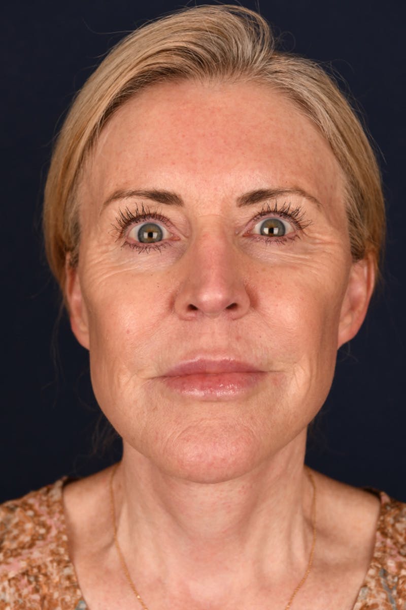 Facelift Before & After Gallery - Patient 9698374 - Image 2