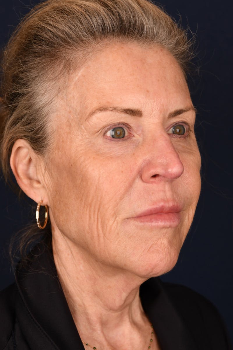 Facelift Before & After Gallery - Patient 9698374 - Image 3