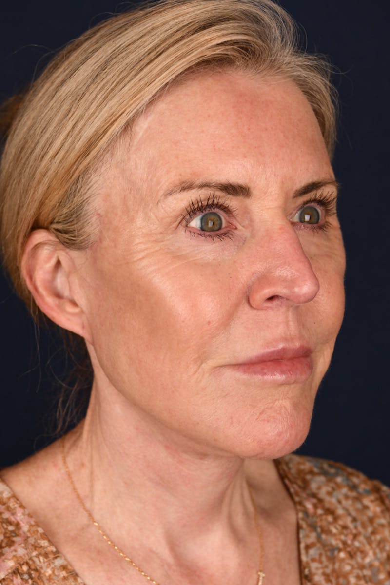 Facelift Before & After Gallery - Patient 9698374 - Image 4