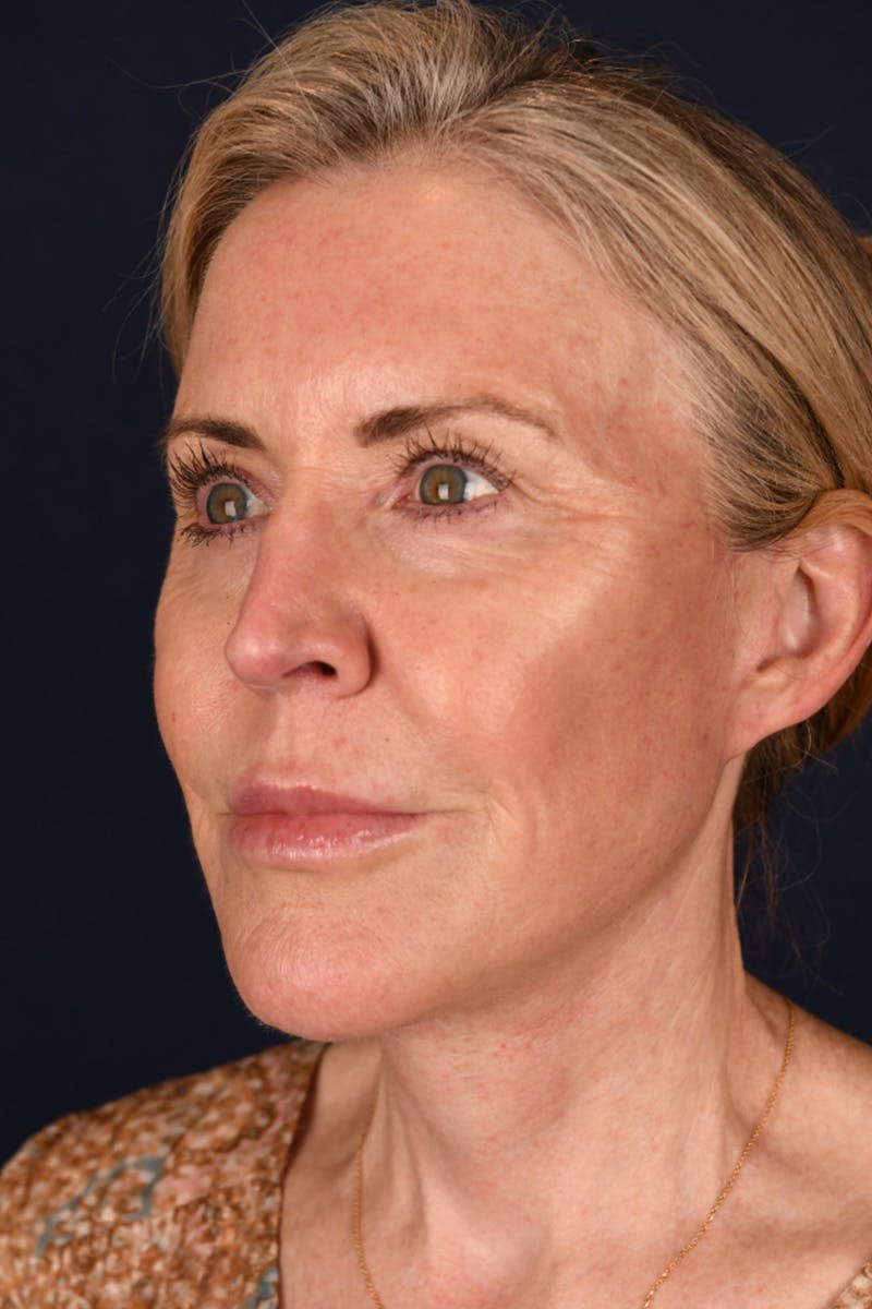 Facelift Before & After Gallery - Patient 9698374 - Image 6