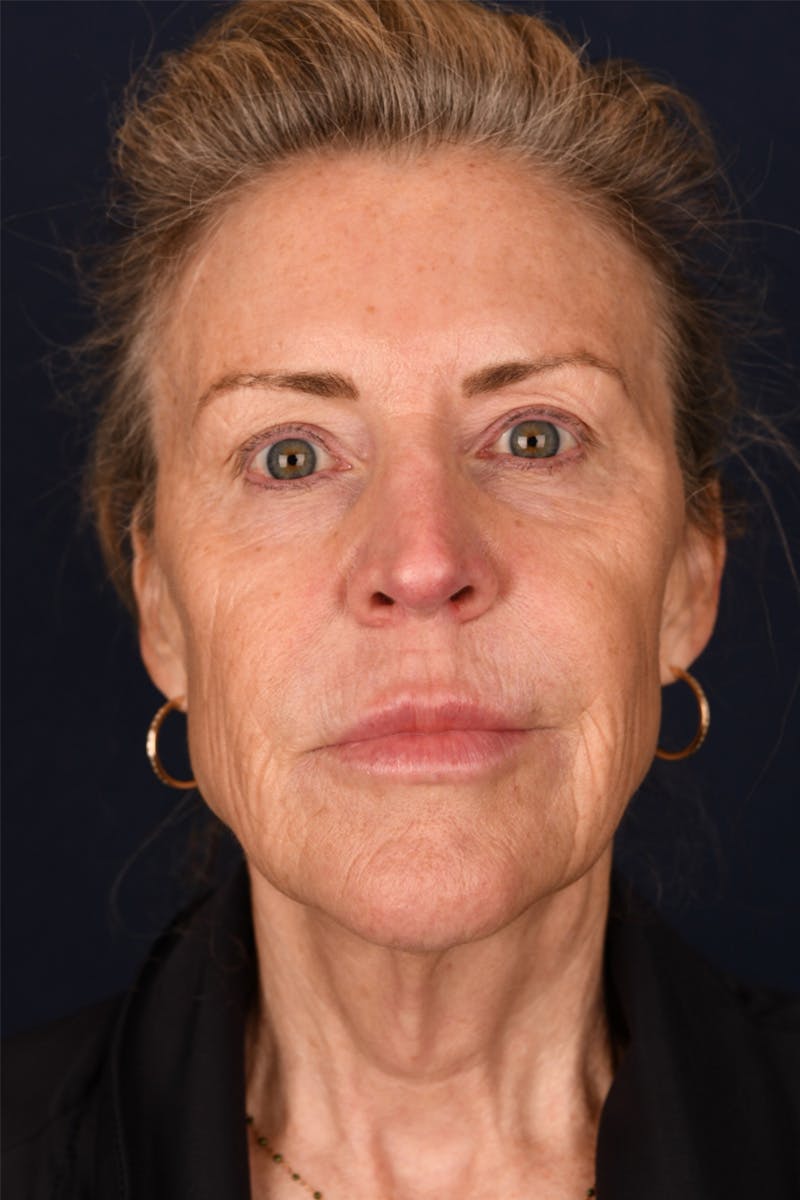 Facelift Before & After Gallery - Patient 9698374 - Image 1