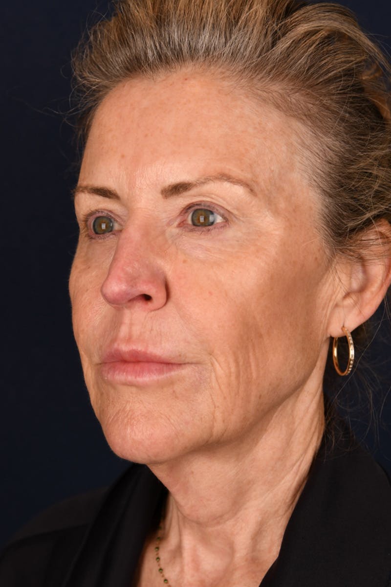 Facelift Before & After Gallery - Patient 9698374 - Image 5