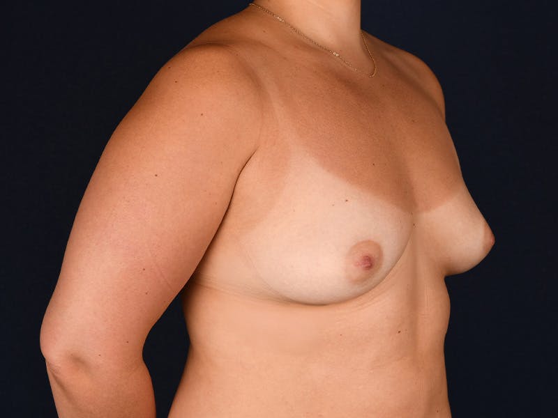 AFT Before & After Gallery - Patient 176849 - Image 3