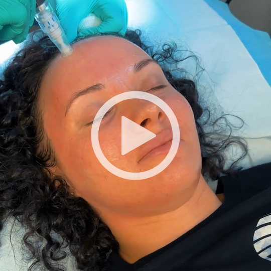 Watch Microneedling treatment video