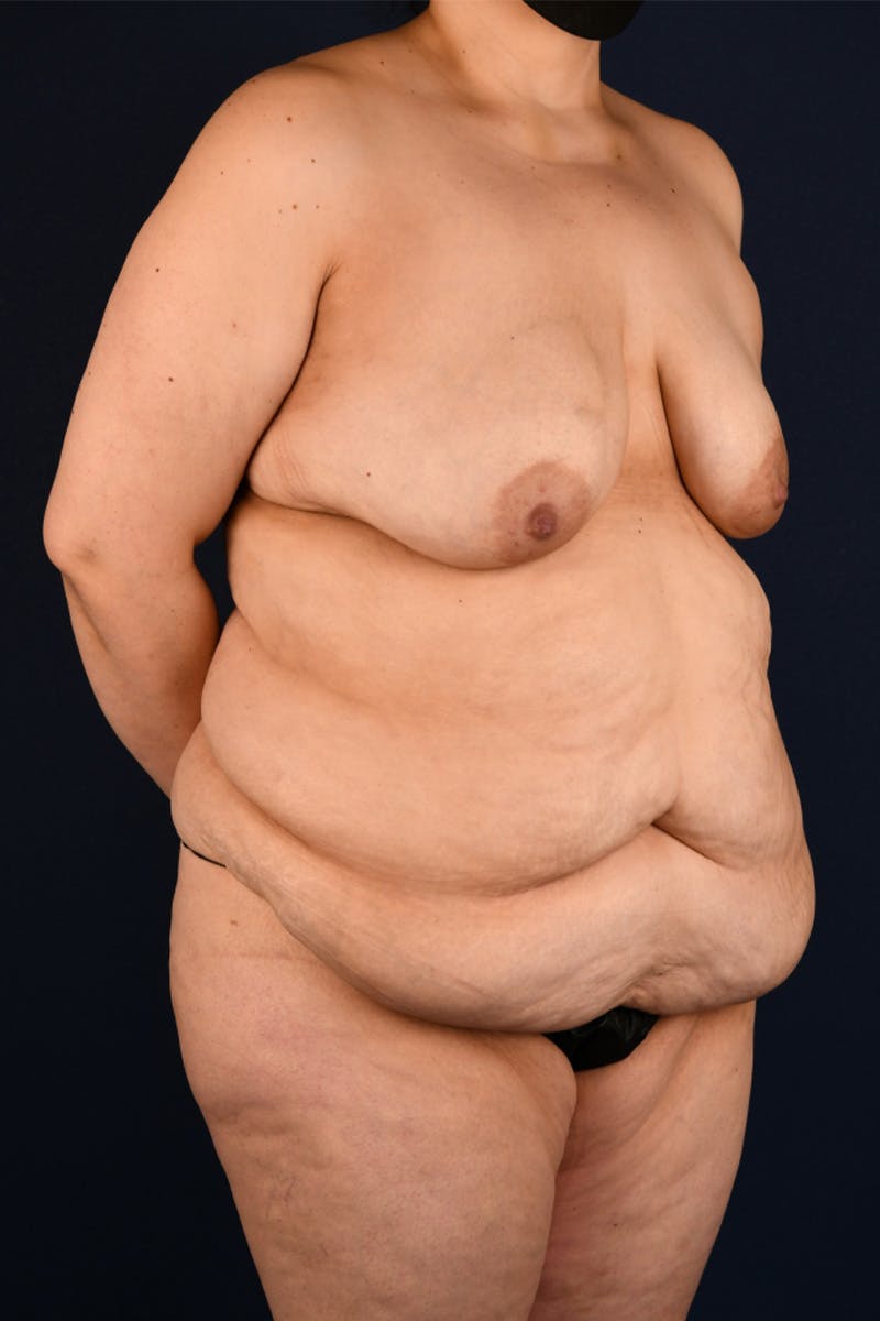 Lower Body Lift Before & After Gallery - Patient 55458446 - Image 3