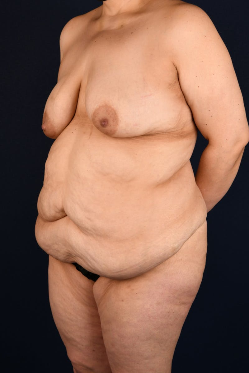 Lower Body Lift Before & After Gallery - Patient 55458446 - Image 5