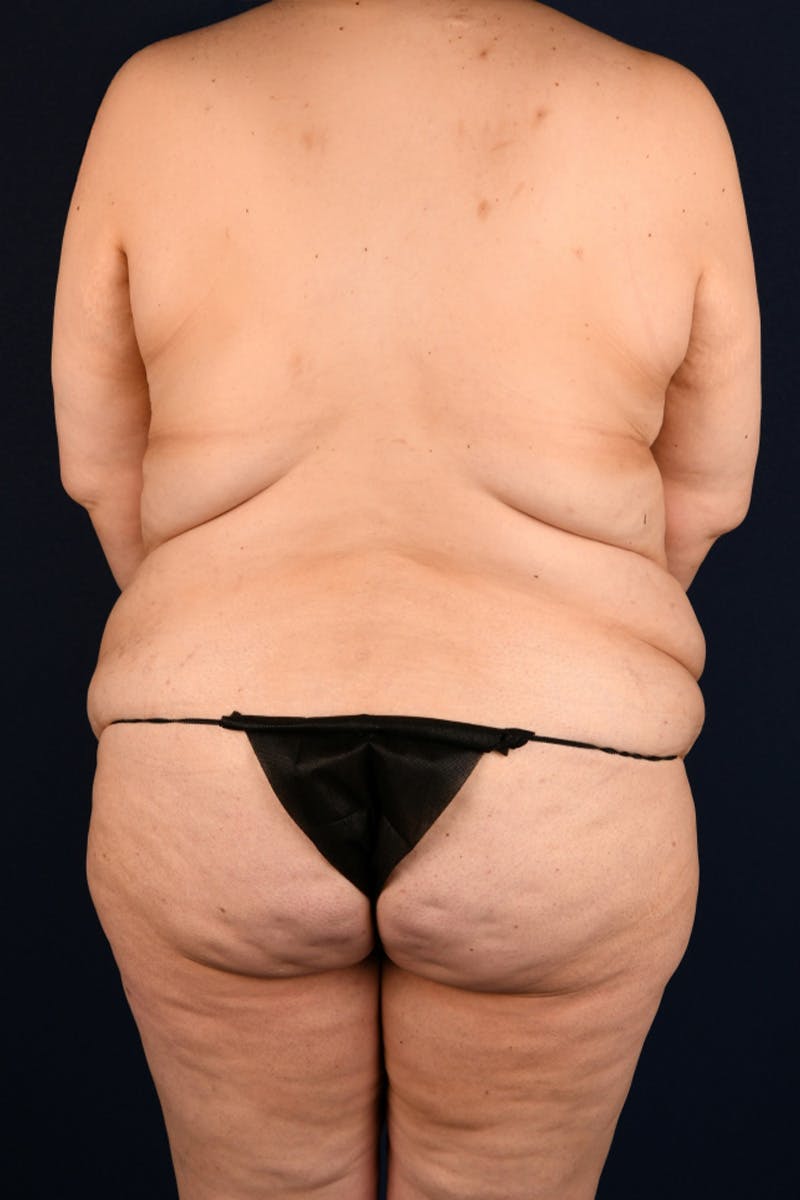 Lower Body Lift Before & After Gallery - Patient 55458446 - Image 1