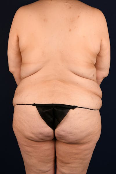 Lower Body Lift Before & After Gallery - Patient 416472 - Image 1