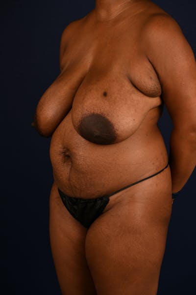 Abdominoplasty Before & After Gallery - Patient 201537 - Image 5