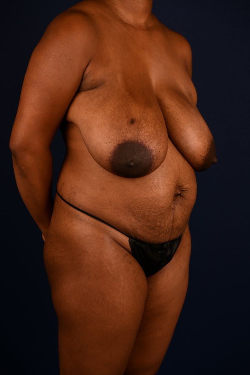 Abdominoplasty Before & After Gallery - Patient 201537 - Image 3