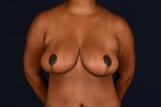 Breast Reduction Before & After Gallery - Patient 830129 - Image 2