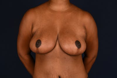 Breast Reduction Before & After Gallery - Patient 830129 - Image 2