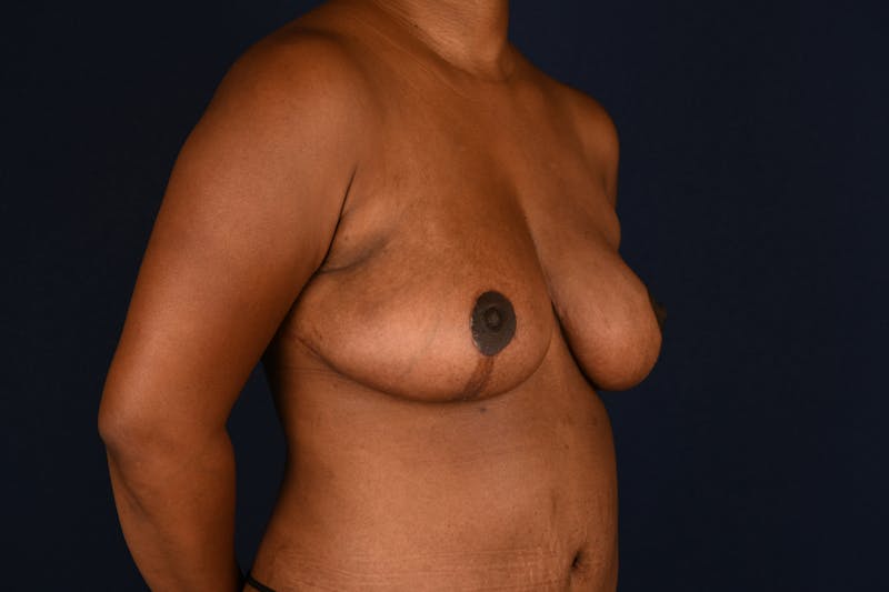 Breast Reduction Before & After Gallery - Patient 830129 - Image 4