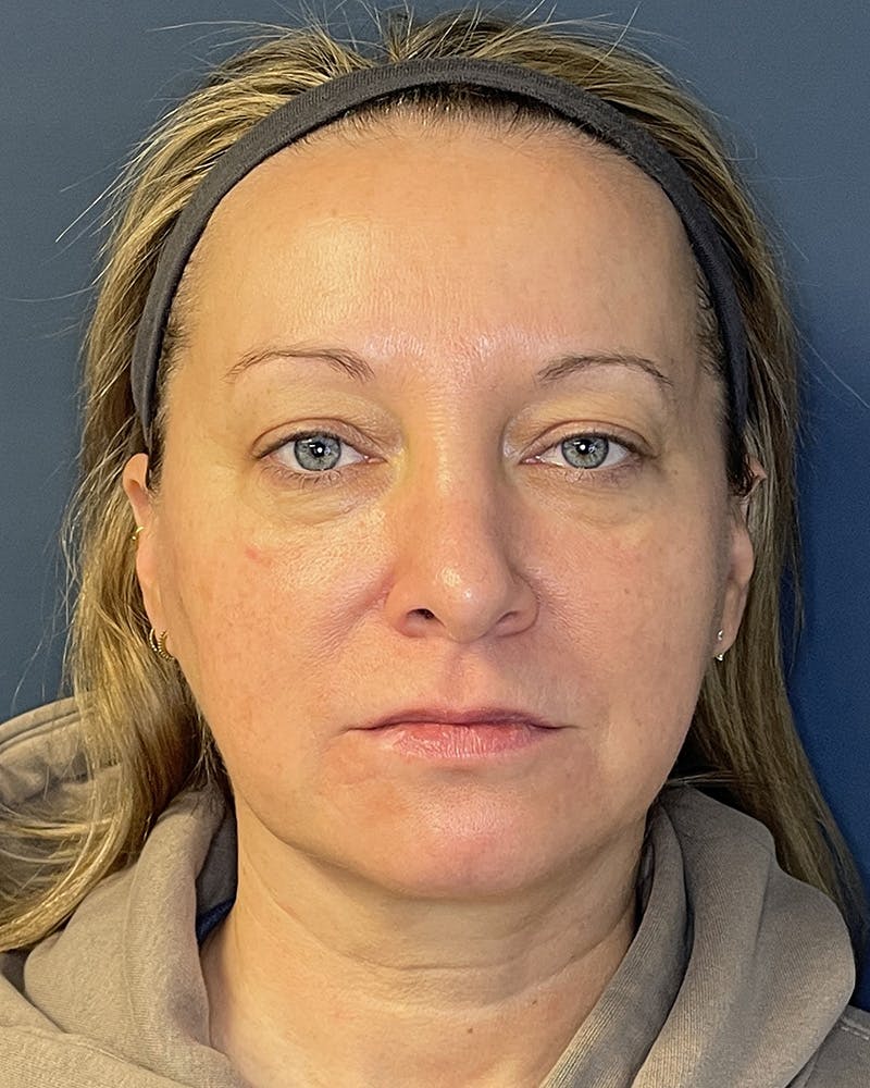 Laser Skin Resurfacing Before & After Gallery - Patient 157429 - Image 1