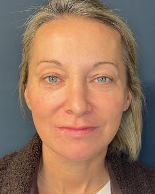 Laser Skin Resurfacing Before & After Gallery - Patient 157429 - Image 2
