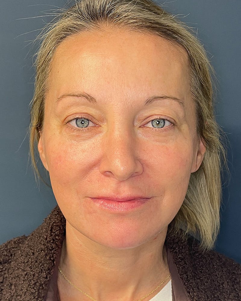 Laser Skin Resurfacing Before & After Gallery - Patient 157429 - Image 2