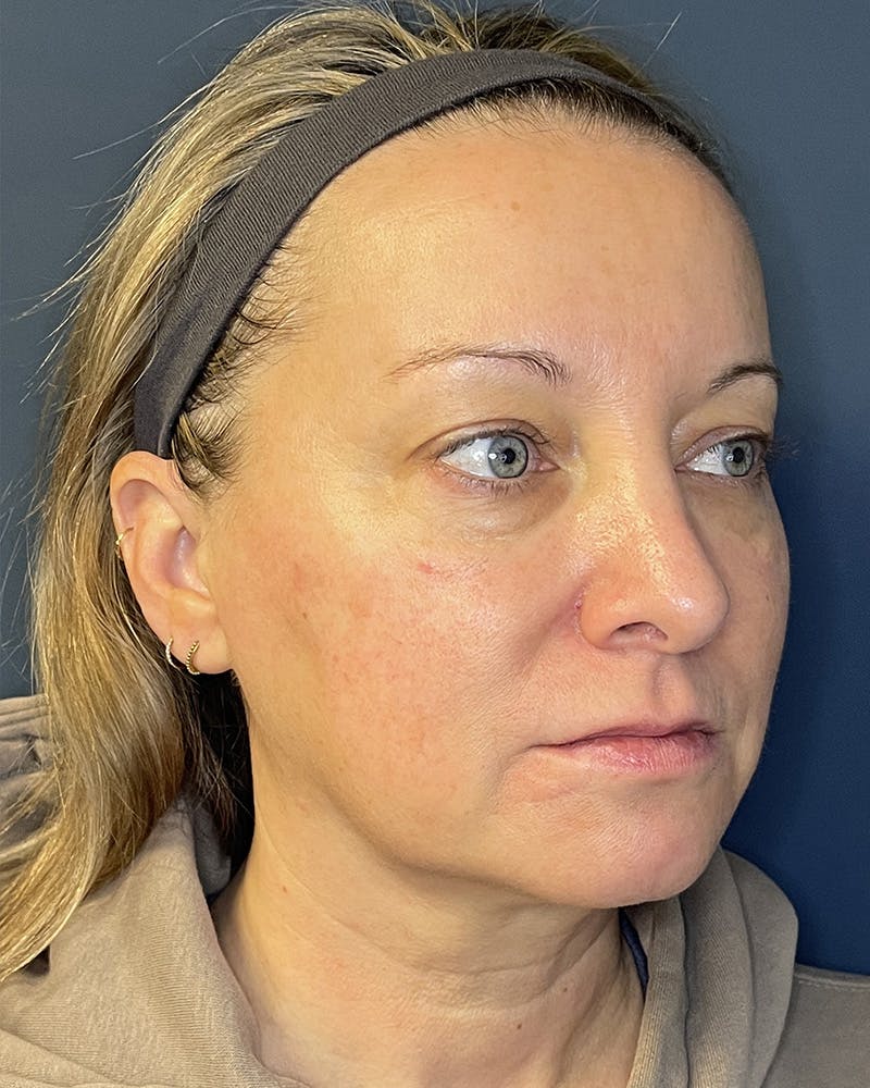 Laser Skin Resurfacing Before & After Gallery - Patient 157429 - Image 3