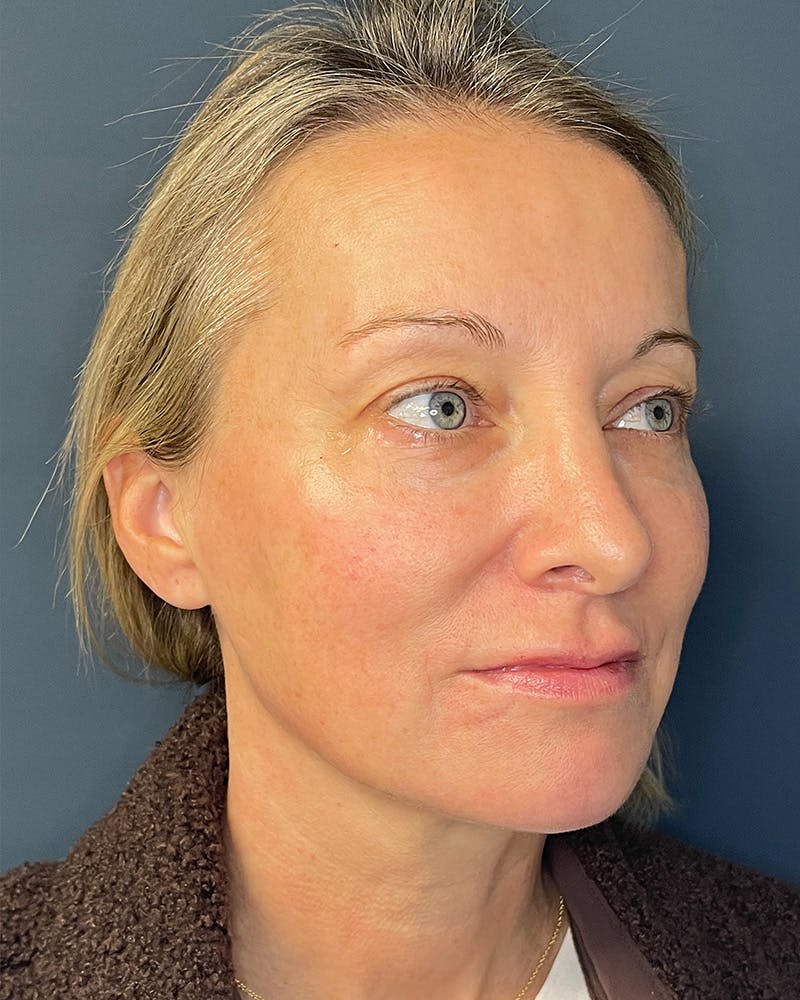 Laser Skin Resurfacing Before & After Gallery - Patient 157429 - Image 4