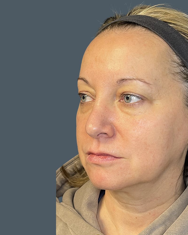 Laser Skin Resurfacing Before & After Gallery - Patient 157429 - Image 5
