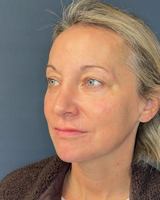 Laser Skin Resurfacing Before & After Gallery - Patient 157429 - Image 6