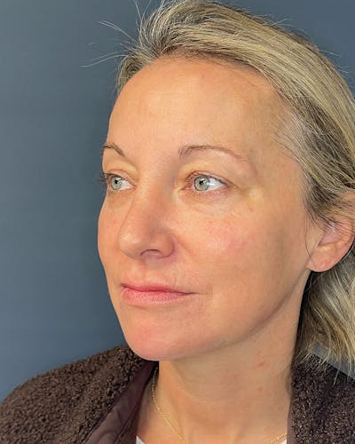 Laser Skin Resurfacing Before & After Gallery - Patient 157429 - Image 6