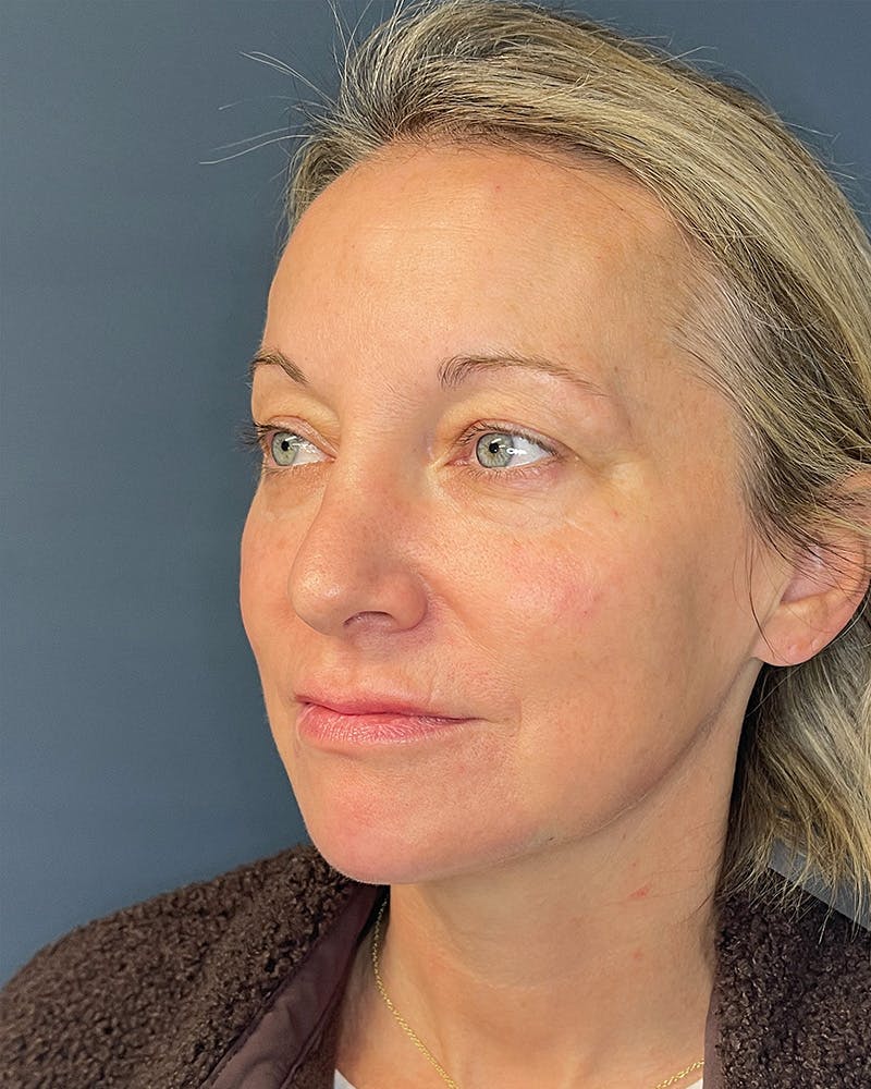 Laser Skin Resurfacing Before & After Gallery - Patient 157429 - Image 6