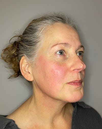 BBL Before & After Gallery - Patient 303967 - Image 4