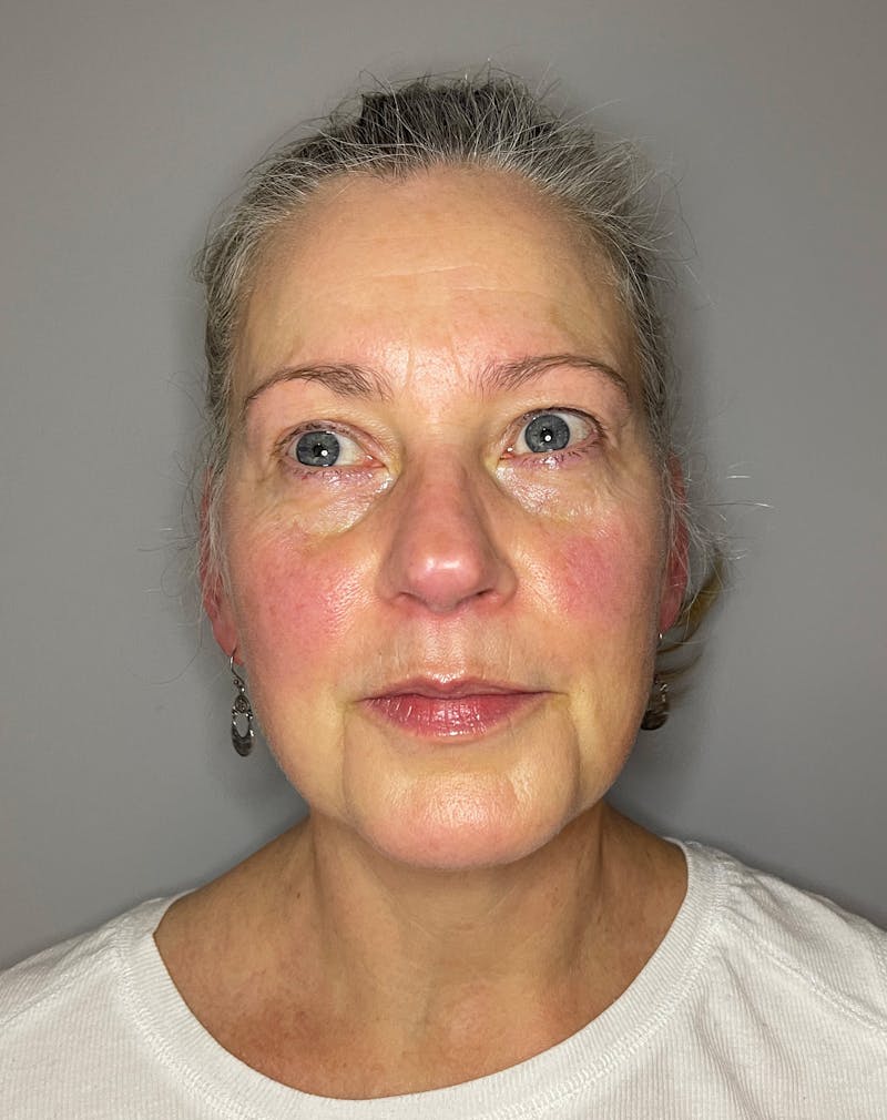 Laser Skin Resurfacing Before & After Gallery - Patient 375680 - Image 1