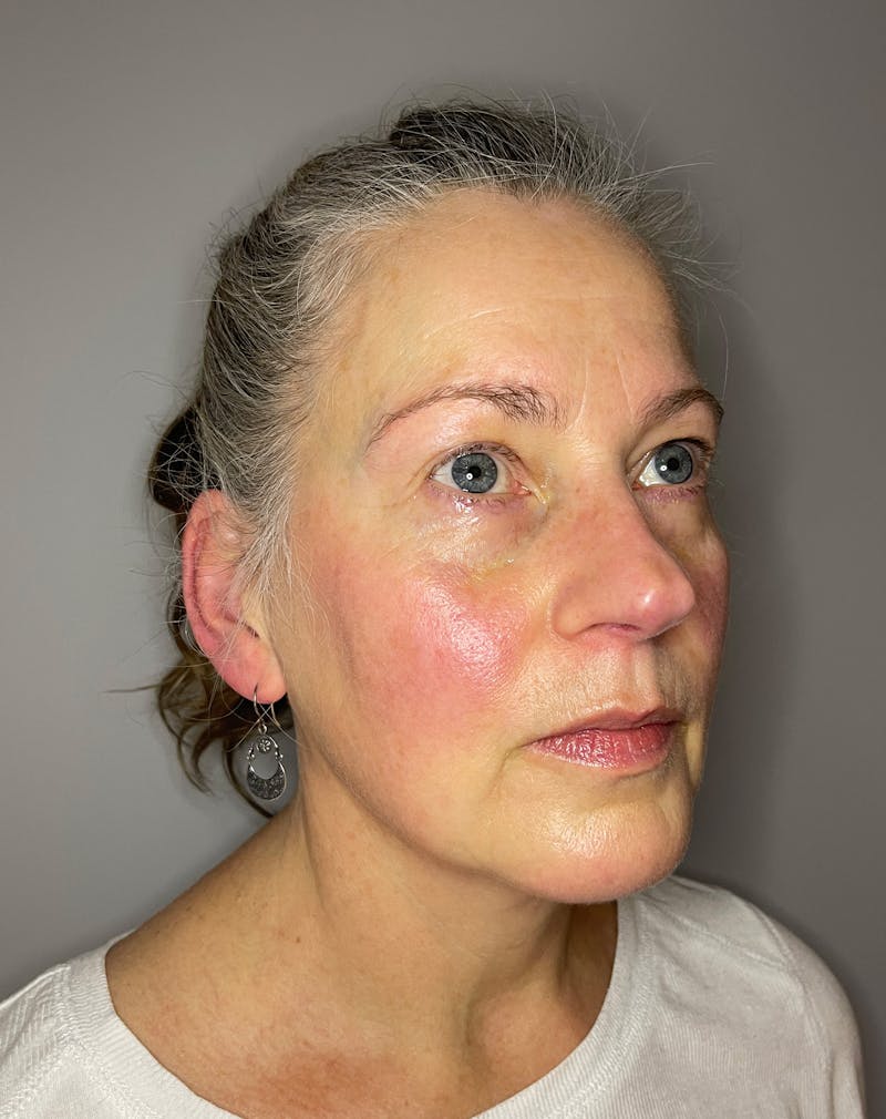 Laser Skin Resurfacing Before & After Gallery - Patient 375680 - Image 3
