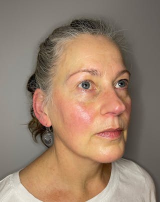 BBL Before & After Gallery - Patient 303967 - Image 4