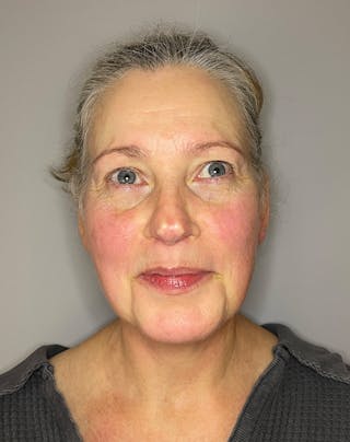 BBL Before & After Gallery - Patient 303967 - Image 2