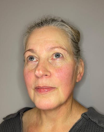 BBL Before & After Gallery - Patient 303967 - Image 6