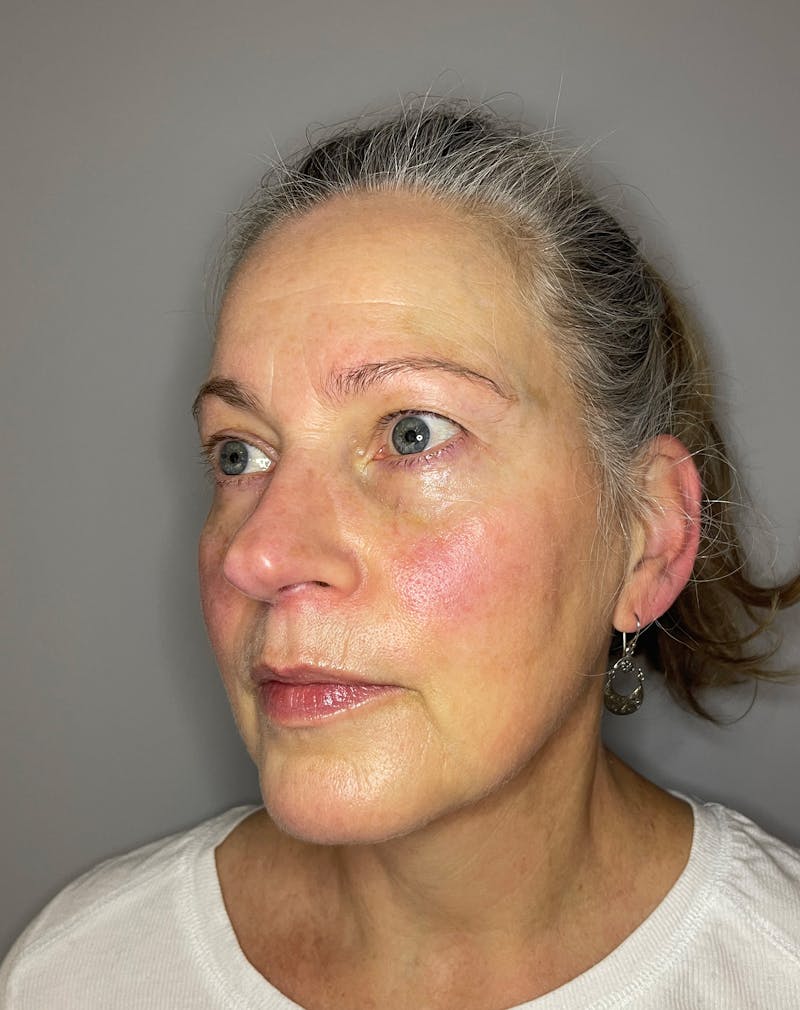 Laser Skin Resurfacing Before & After Gallery - Patient 375680 - Image 5