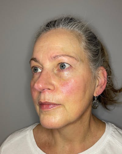 BBL Before & After Gallery - Patient 303967 - Image 5