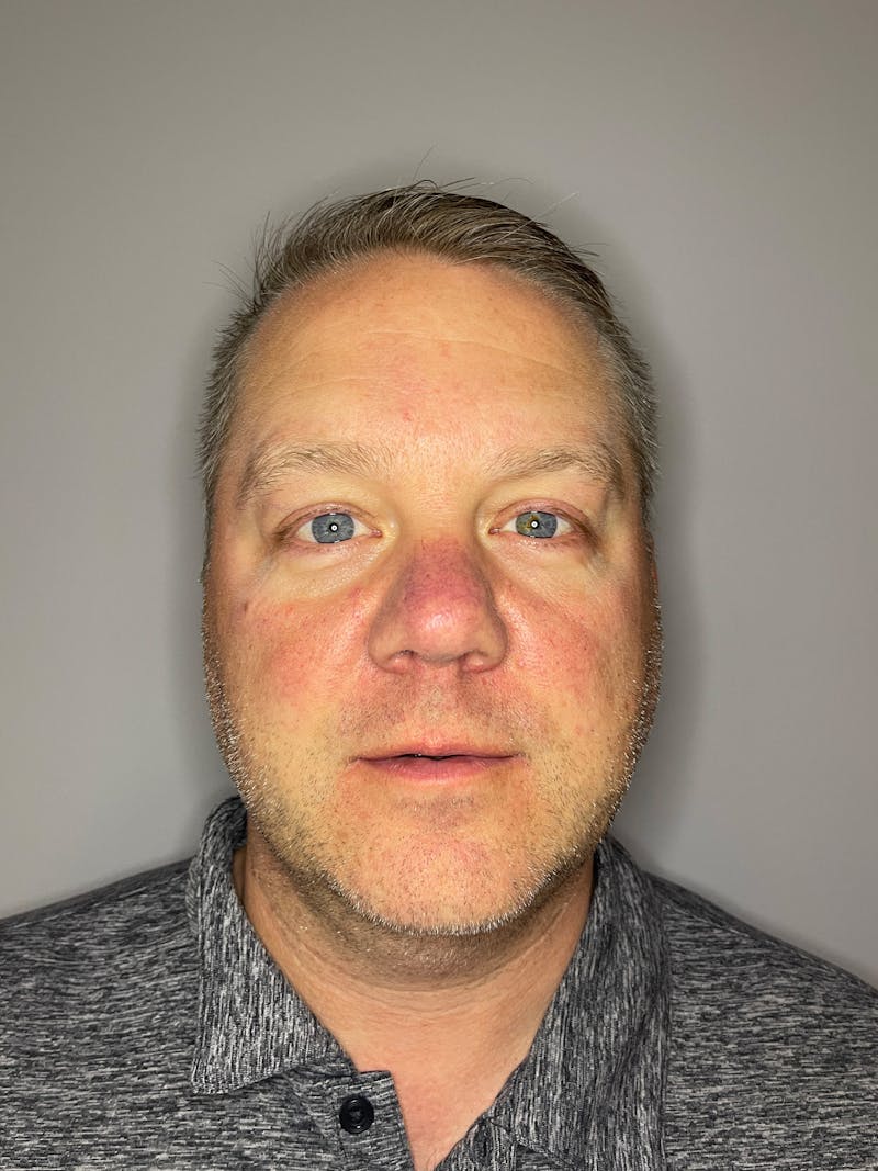 Laser Skin Resurfacing Before & After Gallery - Patient 141373 - Image 2