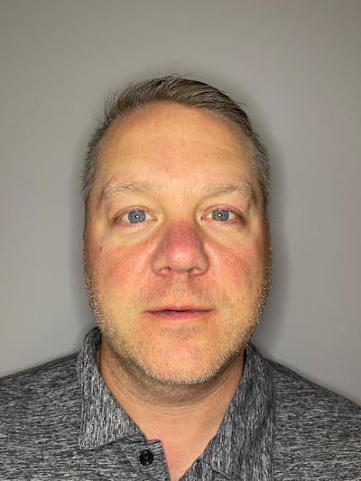 BBL Before & After Gallery - Patient 872466 - Image 2