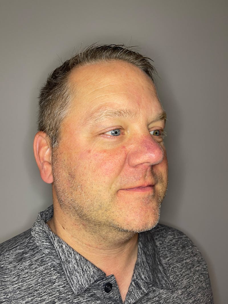 Laser Skin Resurfacing Before & After Gallery - Patient 141373 - Image 4