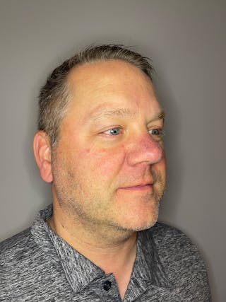 BBL Before & After Gallery - Patient 872466 - Image 4