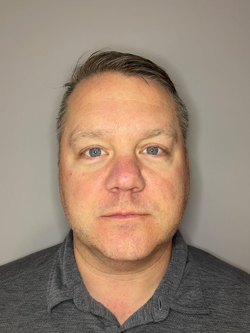 Laser Skin Resurfacing Before & After Gallery - Patient 141373 - Image 1