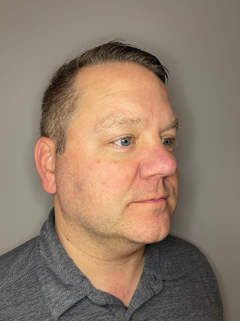 Laser Skin Resurfacing Before & After Gallery - Patient 141373 - Image 3