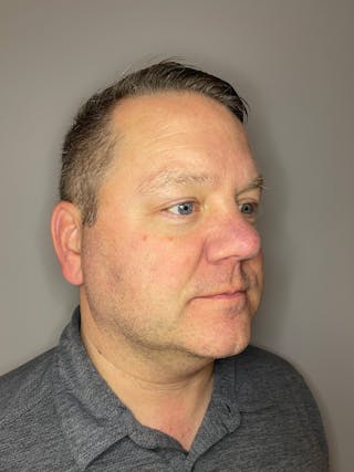 BBL Before & After Gallery - Patient 872466 - Image 4