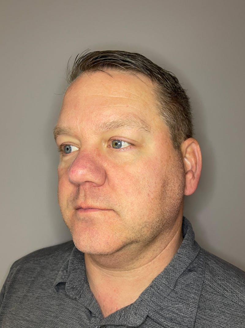 Laser Skin Resurfacing Before & After Gallery - Patient 141373 - Image 5