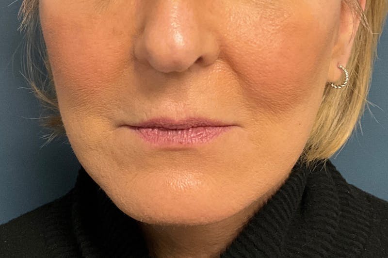 Facial Fillers Before & After Gallery - Patient 151442 - Image 1