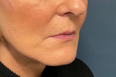 Facial Fillers Before & After Gallery - Patient 151442 - Image 3