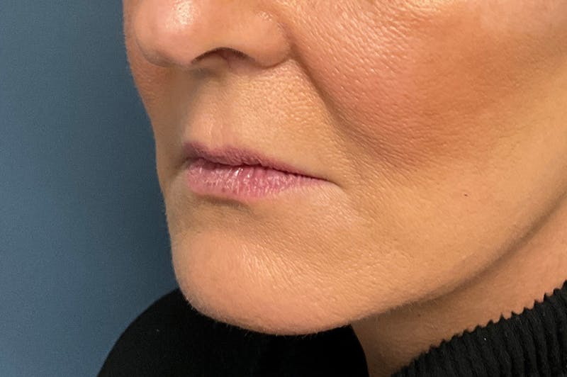 Facial Fillers Before & After Gallery - Patient 151442 - Image 5