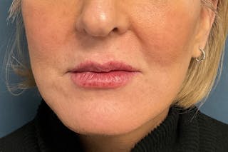 Facial Fillers Before & After Gallery - Patient 151442 - Image 2