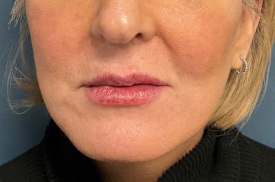 Facial Fillers Before & After Gallery - Patient 151442 - Image 2