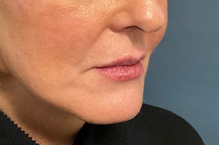 Facial Fillers Before & After Gallery - Patient 151442 - Image 4